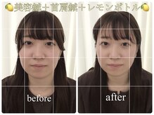 アキュモンド 渋谷院(acumond)/むくみ・二重顎改善◎ 20代後半