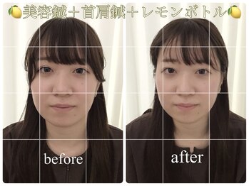 アキュモンド 渋谷院(acumond)/むくみ・二重顎改善◎ 20代後半