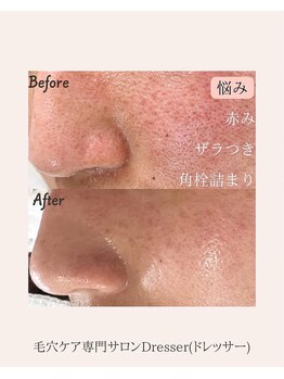 ドレッサー(Dresser)/赤ら顔角栓詰まりから抜け出せた