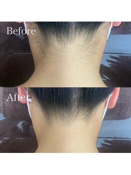 ベルカーラ(Belcarra)/レディース脱毛/うなじ、襟足