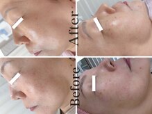 光フェイシャル3回施術☆綺麗な艶肌に♪ハーブピーリングも◎