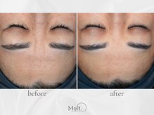 メルト 中目黒(Melt.)/◇表情ジワ改善導入ケア