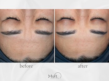 メルト 中目黒(Melt.)/◇表情ジワ改善導入ケア