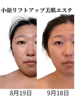 トータルボディケア きみんちの写真/フェイスラインのもたつきや頬のたるみ、食いしばりによるお悩みの方へ