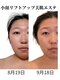 トータルボディケア きみんちの写真/フェイスラインのもたつきや頬のたるみ、食いしばりによるお悩みの方へ