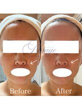 ニュアージュ(Nuage)/30代女性　１回の変化