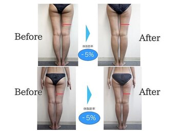 ミューズファクトリー(Muse factory)/セル脂肪にアプローチ