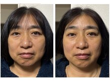 ラムーン(La.Moon)/美容鍼1回「クマ」にアプローチ