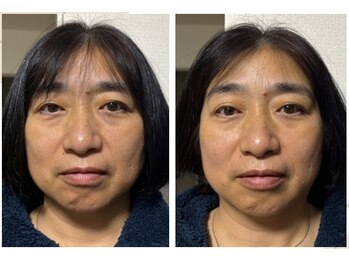 ラムーン(La.Moon)/美容鍼1回「クマ」にアプローチ