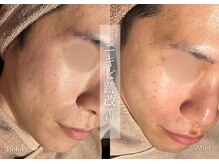 シューラディアント(ShuRadiant)/エンビロン/レチノール/メンズ