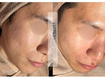 シューラディアント(ShuRadiant)/エンビロン/レチノール/メンズ