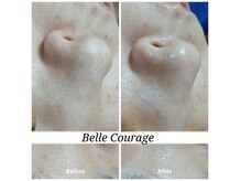 ベルクラージュ(Belle Courage)の雰囲気（剥離・ダウンタイムなし！ハーブピーリングで毛穴の黒ずみ一掃）