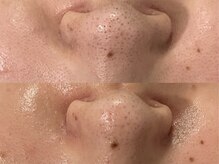 エメ 心斎橋(Aimer)の雰囲気（お手入れの定番！『毛穴洗浄』一度でも満足できる結果です☆）