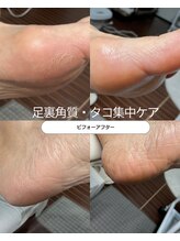 ルミエールサント(lumiere sainte)/足裏角質・タコ集中ケアコース