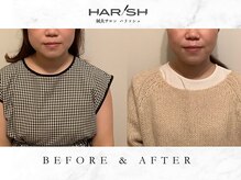 ハリッシュの雰囲気（フェイスラインを引き締め維持できる状態へ）