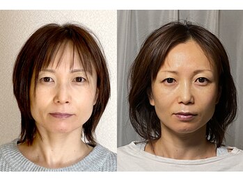 美容整体 アルマ/筋肉をゆるめてから→ひきしめ