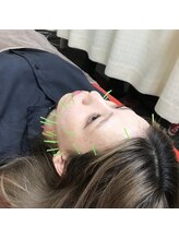 よつば鍼灸整骨院 春日院/美容鍼