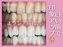 エクシアホワイトニング 岡崎店/歯の黄ばみ撃退★白さ満足度No.1