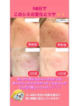 パタティパタタ(PatatiPatata)/10日後のシミ&艶☆