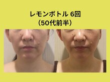 アユアランリンク 札幌店/レモンボトル/50代前半/6回