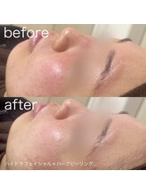 ルルラ リコ(lulula rico)/症例写真/ハーブピーリング