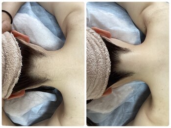 ルルトウキョウ 池袋店(LULU.tokyo)/うなじ脱毛