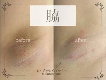 アイサロン(i.salon)/メラニンケア