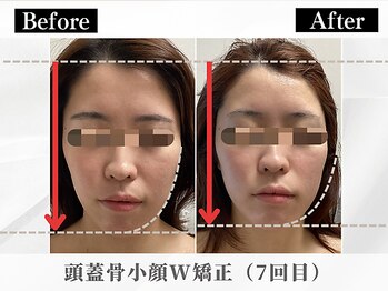 ポーベルポー(Peau Belle poe)/人気No.1/頭蓋骨小顔W矯正7回目