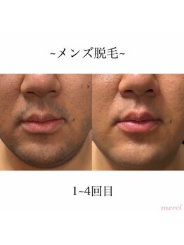 ギンザ111 プライベートルーム(Ginza 111 Private room)/ヒゲ光脱毛