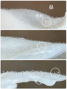 ネオファースト 大阪福島店(NeoFirst)の写真/【目指せ毛穴レス♪】スキンケアの浸透率も格段にUP《艶肌フェイスwax＆エレクトロポレーション》