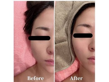 ソリーシェ鍼灸院(SORRISCE)/Before⇒After