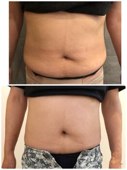 長寿鍼灸院 長寿整骨院/EMS<お腹集中コース>