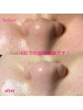 ピュアボーテ(PURE BEAUTE)/毛穴エクストラクション★１回で