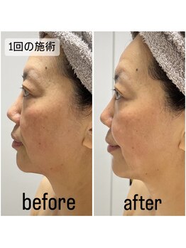 きれい塾 恵比寿/低周波リフト