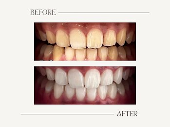 ホワイト つくば店(WHITE)/【20トーンアップ】16回照射