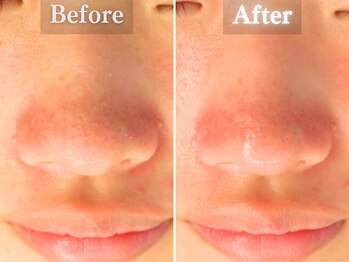 ボーンオム(Born Homme)/毛穴洗浄＋美容液導入：20代女性