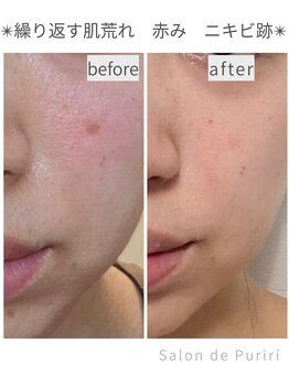 サロン ド プリリ(Salon de Puriri)/ハーブピーリング