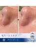 【毛穴ケア・シミケア】ダクトピール｜肌質改善ピーリング