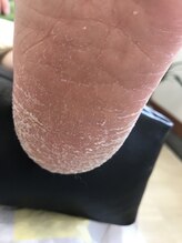 足のケア アンド 巻き爪 エムズ 白金通り店(M's)/乾燥系2
