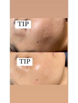 プランス 恵比寿店(PLANCE)/ニキビケア/恵比寿/エステ