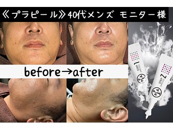 サロンスペース/水光肌【プラピール】モニター様