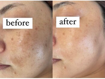 キュル(Kyul)/REVIハーブピーリング