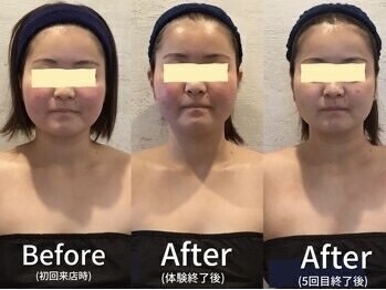 小顔フェイスラボ 袋井店(小顔FaceLabo.)/◆小顔コルギ Before→After◆