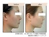 【人気No.2】二重あご脂肪分解×小顔フェイシャル ￥15,000→￥9,900