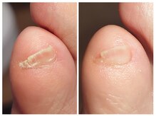 アンティ(Aunty)/小爪（副爪）