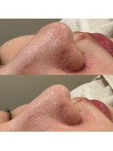 ウィール 栄 矢場町店(WE:LL)/毛穴洗浄(鼻のみ)