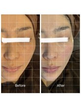 ラビ(RABBI)/30代女性レモンボトル小顔EMS