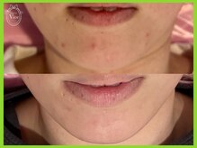 ヴィオール 名古屋栄店(VIOR)/肌質改善 ハーブピーリング