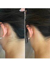 インベスト(INVEST)/うなじ脱毛