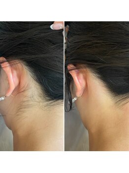 インベスト(INVEST)/うなじ脱毛